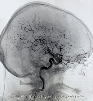 Mozgová angiografia (http://www.stockphotos.sk/)